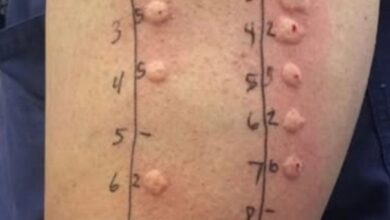 Viu isto na pele ao acordar? Veja o que pode ser e quando se preocupar